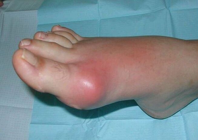 Clinical picture of arthritis of the foot - edema and inflammation