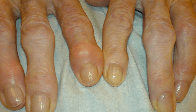 pain in the joints of fingers with osteoarthritis