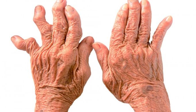 rheumatoid arthritis as a cause of pain in the joints of the fingers