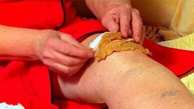 Compresses for knee arthrosis joint