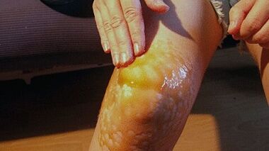 Destruction to treat knee arthrosis joint