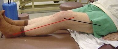 Progressive arthrosis of the knee joint