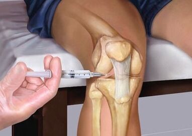 Injection into the joint