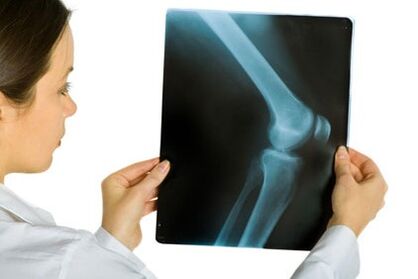 Treatment of knee arthrosis joint