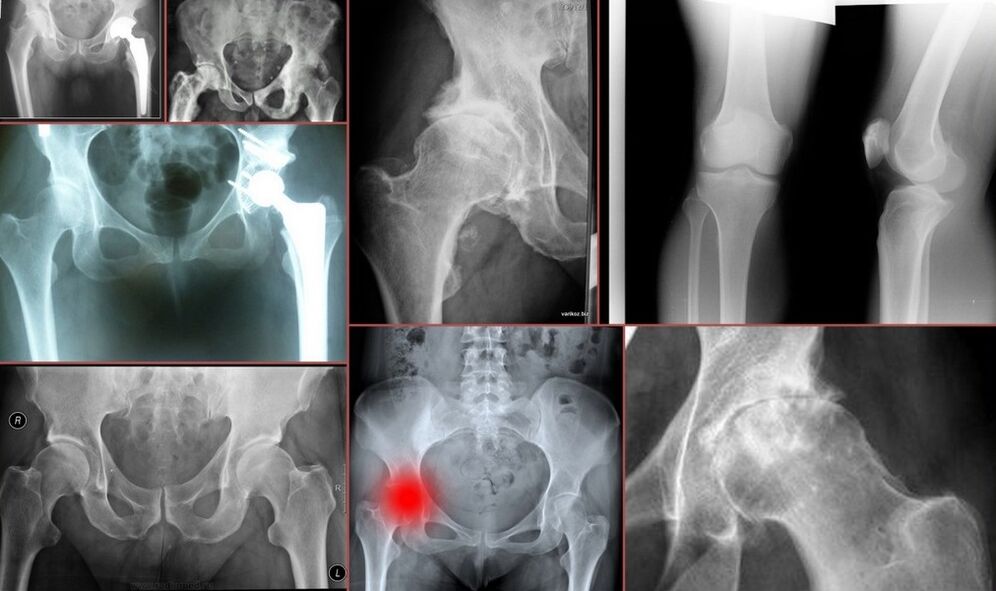 X-ray for pain in the hip joint